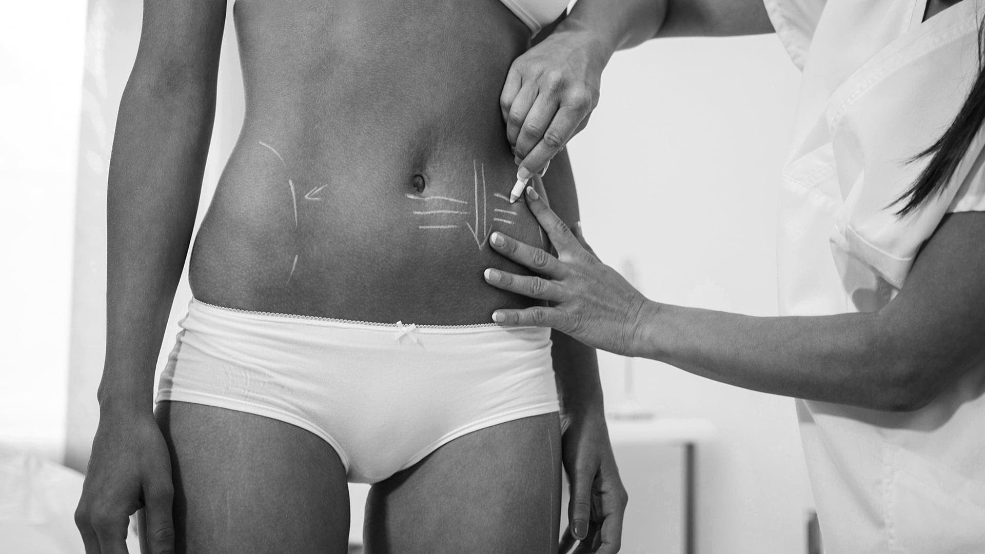 Abdominoplasty (Tummy Tuck)